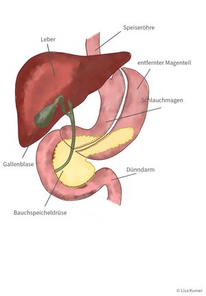 Grafische Darstellung eines Schlauchmagens