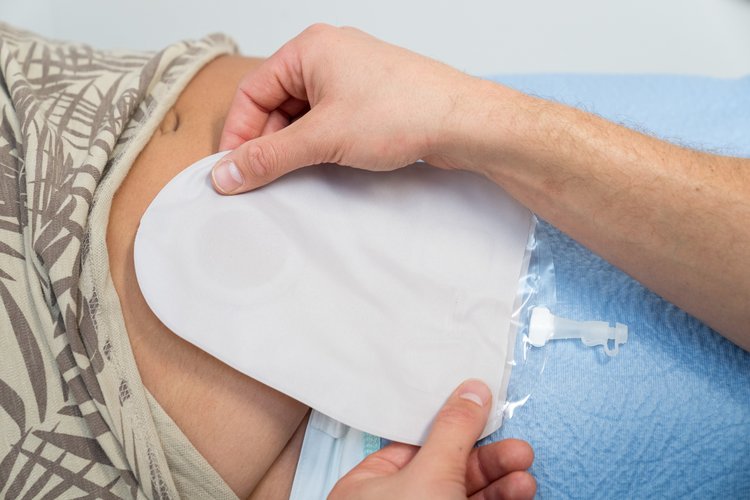 Anlage einer Stomaversorgung: Beutel wird sorgfältig auf den Bauch positioniert.