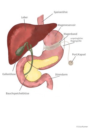 Grafische Darstellung eines Magenbands