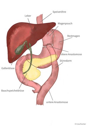 Grafische Darstellung eines Magenbypass