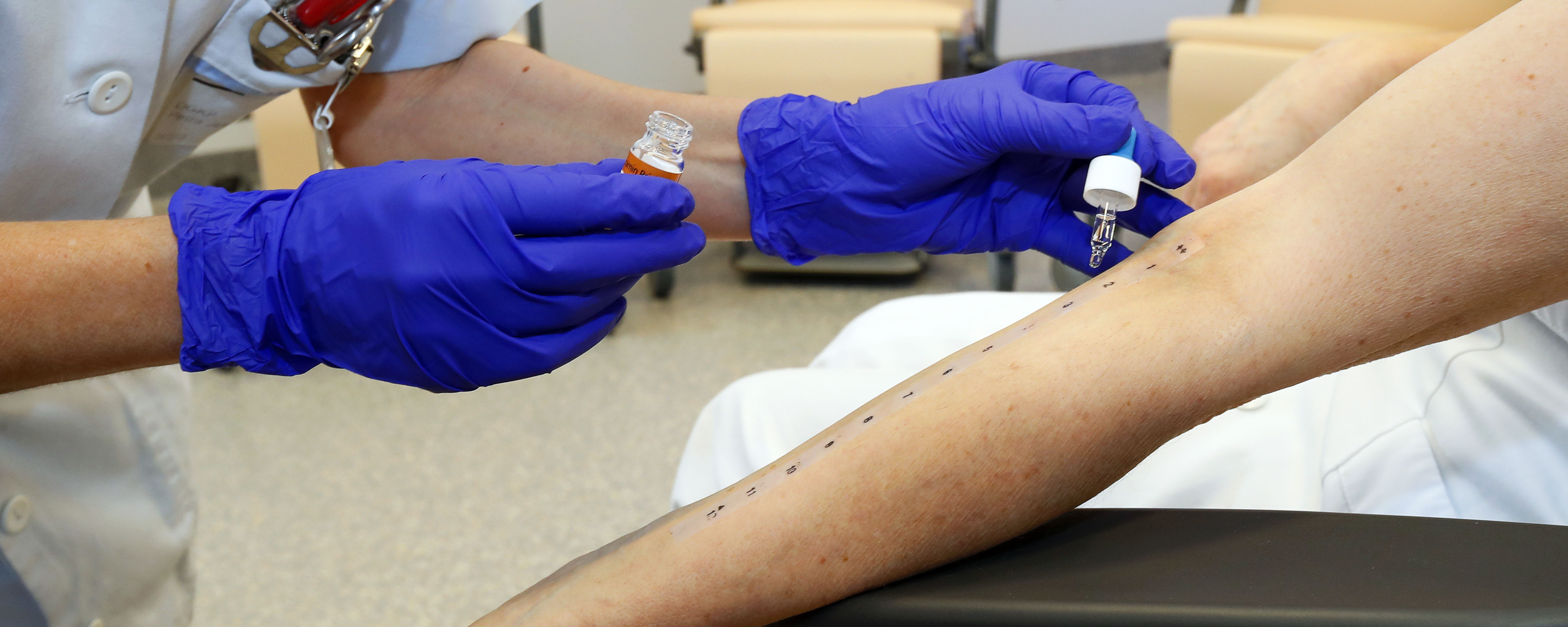 Allergietest wird am Arm durchgeführt.